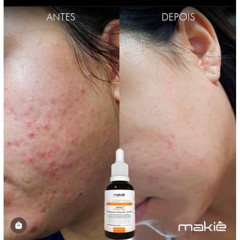 Sérum Vitamina C, Clareador Natural da Pele,Reduz Rugas,Acnes e Machas Skin Care,Uso diário
