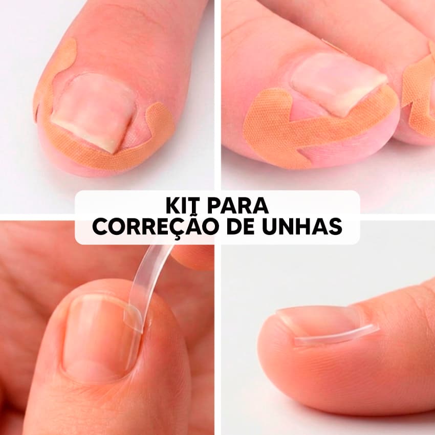 Kit para Correção de Unhas Desencravar – Corretores + Adesivos Ortopédicos (Cuidado Completo)