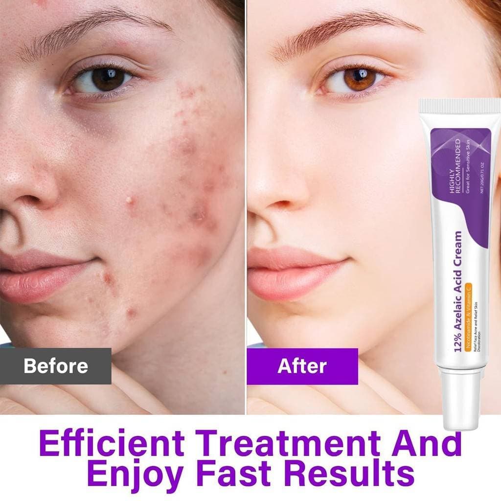 Creme De Ácido Azelaico Niacinamida 20g Vitamina C Iluminador Calmante Cuidados Com A Pele Facial
